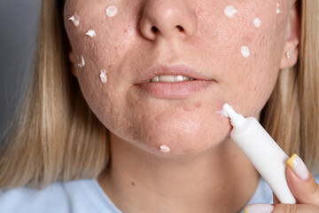 Woman applying cream onto face, closeup. Acne treatment