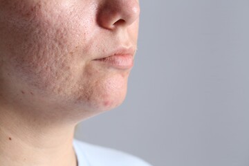 Obraz premium Woman with acne problem on grey background, closeup. Space for text