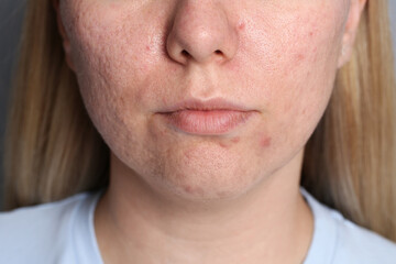 Obraz premium Closeup view of woman with acne problem
