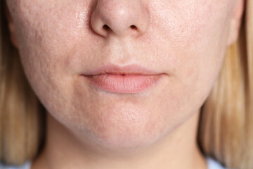 Fototapeta premium Closeup view of woman after cosmetic procedure