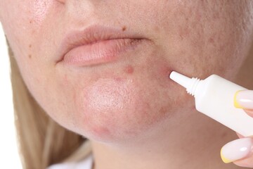 Woman applying cream onto face, closeup. Acne treatment