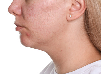 Woman with acne problem on white background, closeup