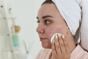 Woman with acne problem cleaning her face near mirror indoors, space for text
