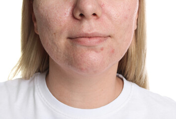 Obraz premium Woman with acne problem on white background, closeup