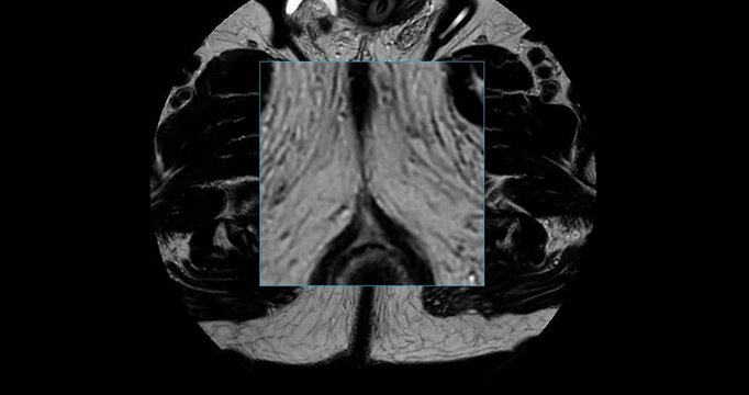 MRI scan reveals an enlarged prostate gland, a possible indicator of prostate cancer. Explore the critical signs and how MRI can assist in early detection.