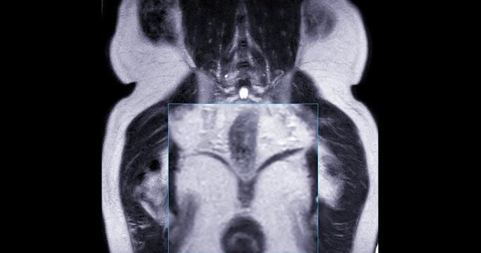 MRI scan reveals an enlarged prostate gland, a possible indicator of prostate cancer. Explore the critical signs and how MRI can assist in early detection.