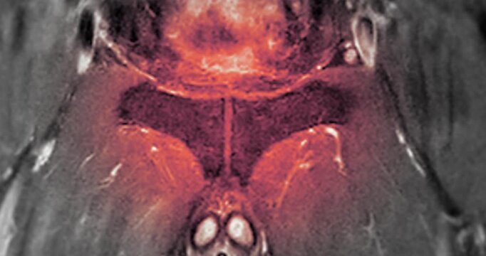 MRI scan reveals an enlarged prostate gland, a possible indicator of prostate cancer. Explore the critical signs and how MRI can assist in early detection.