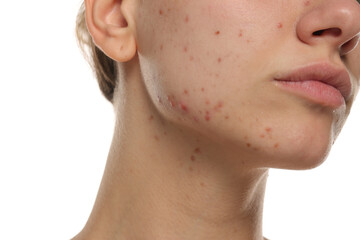 Close-up of young woman's jawline with visible acne, studio shot on white background.