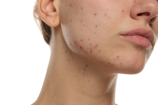 Close-up of young woman's jawline with visible acne, studio shot on white background.