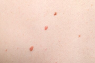 Woman with moles on her body, closeup