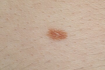 Woman with mole on her body, closeup