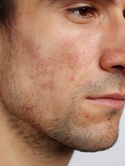 Obraz premium Close-up of a cheek with a slight allergic reaction, redness, and peeling. Suitable for showing sensitive skin or for advertising products for sensitive skin.