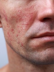 Obraz premium Close-up of a cheek with a slight allergic reaction, redness, and peeling. Suitable for showing sensitive skin or for advertising products for sensitive skin.