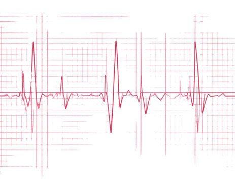 ECG Heartbeat Tracing on Graph Paper with Regular Sinus Rhythm, Isolated on Transparent Background PNG