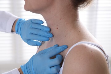 Doctor examining woman's moles in hospital, closeup