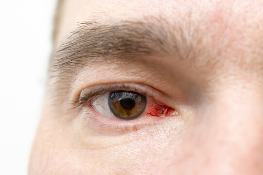 Close up of male eye with red blood vessels and irritation, showing symptom of conjunctivitis, eye infection or dry eye condition