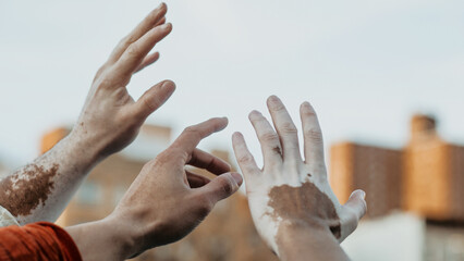 Hands reaching toward the sky in unity, showing vitiligo diversity and connection outdoors