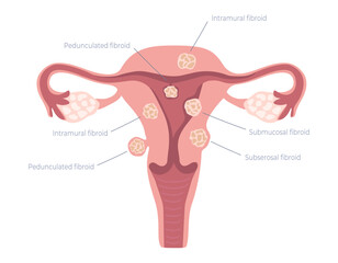 Female uterus with common types of uterine fibroids. Educational medical diagram for use in infographics on gynecology, women's health and reproductive system. Vector illustration isolated