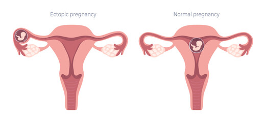 Medical infographic on the topic of ectopic and normal pregnancy. Fertilization and related problems, gynecology, fertility. Vector illustration