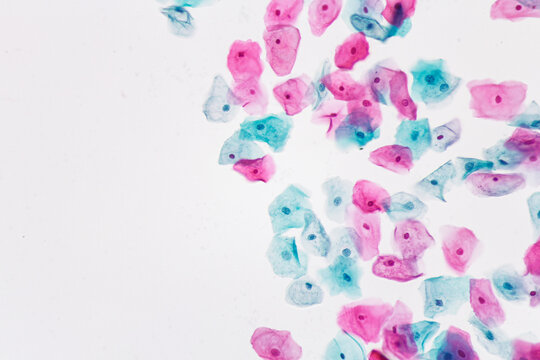 View in microscopic of normal human cervix cells.Squamous epithelial cells from pap smear cervixl and vaginal woman.Cervical cancer screening test.
