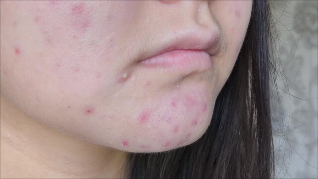 post-acne, scars and red festering pimples on the face of a young woman. concept of skin problems and harmonic failure