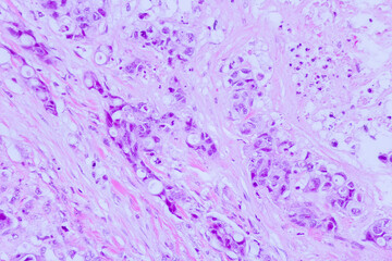 Backgrounds of human cells tissue of lung human under the microscope in pathology lab.View in...