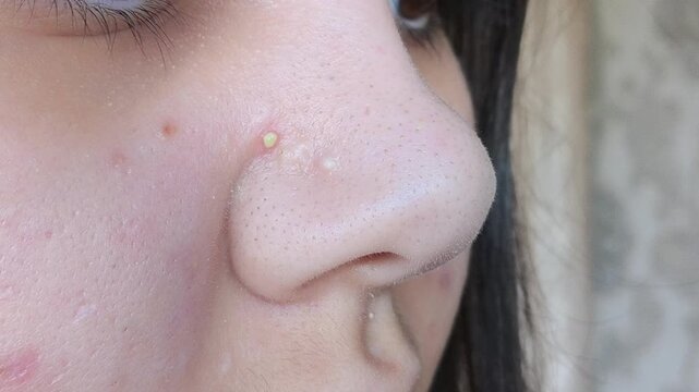 Close-up of woman's nose with blackheads or black dots before and after peeling and cleansing the face isolated on a white background. Acne problem, comedones. Cosmetology dermatology concept