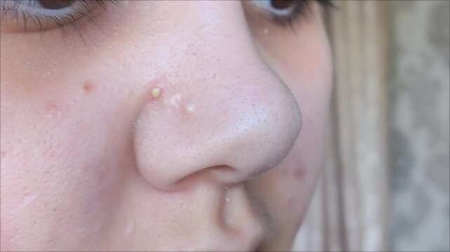 Close-up of woman's nose with blackheads or black dots before and after peeling and cleansing the face isolated on a white background. Acne problem, comedones. Cosmetology dermatology concept