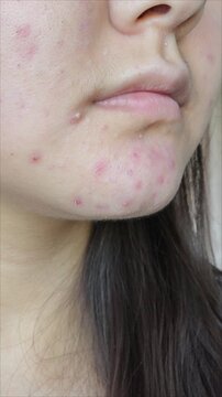 post-acne, scars and red festering pimples on the face of a young woman. concept of skin problems and harmonic failure