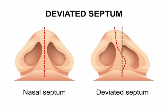 Deviated Septum Nose Surgery Illustration