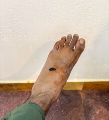 Close up photo of a Leech on a man's foot