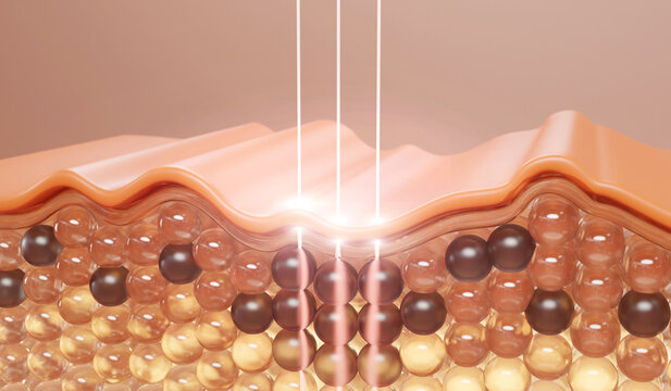 3D illustration of laser treatment targeting dark pigmented cells in skin. Skincare and dermatology concept for pigmentation, melasma, and spot removal.

