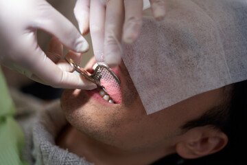 歯の型取りイメージ