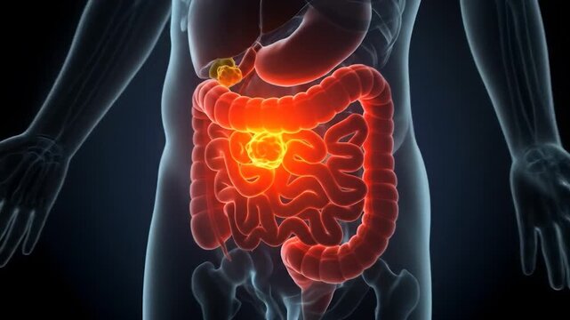 Illuminated 3D Intestinal Tumor, Digestive System, Medical Illustration