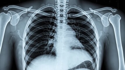 Radiographic chest X-ray image used for tuberculosis and COVID-19 diagnostic screening purposes