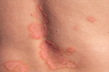 Fototapeta premium Understanding Psoriasis Through Close-Up Skin Detail Showing the Condition on the Back With Patches and Redness Visible