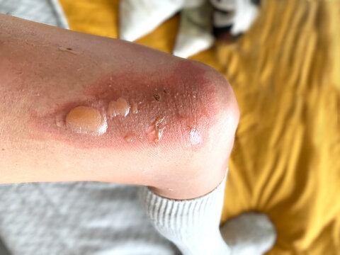 Woman leg blistered and red skin from accidental scalds.