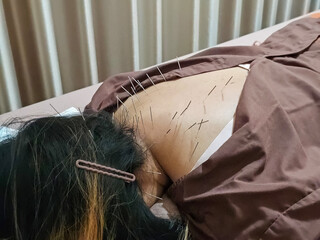 An Asian woman lying face down on her back receiving acupuncture, alleviating back pain and treating muscle injuries. Office Syndrome