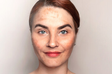 Red hair womans face with pigmentation, melasma, freckles, age spots photo. Close up photo