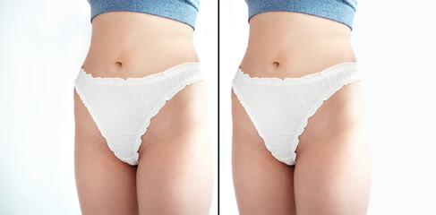 Young beauty woman wear bikini with hair removal problem - before and after concept