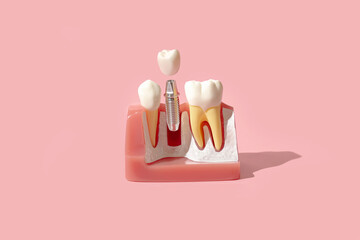 Dental model of implantation and tooth crown. Creative concept on pastel background