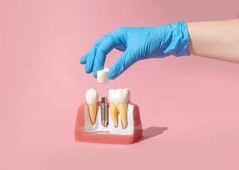Dental model of implantation and tooth crown. Creative concept on pastel background