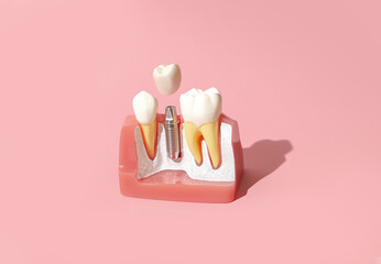 Dental model of implantation and tooth crown. Creative concept on pastel background