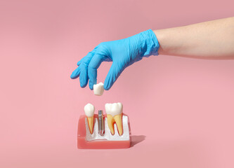 Dental model of implantation and tooth crown. Creative concept on pastel background