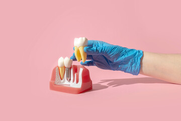 Dental model of implantation and tooth crown. Creative concept on pastel background