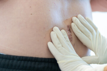 Medical professional is gently inspecting a surgical site located on the abdomen of a patient. The...