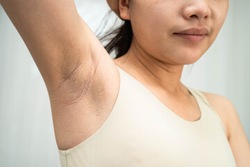 Asian woman have problem black armpit beauty skin care.