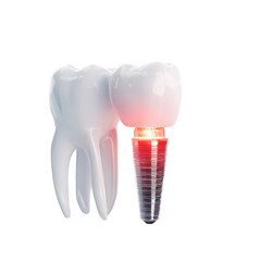 3D rendering of a dental implant abutting a healthy tooth, showing the implant's screw-like structure and a subtle red glow at the implant-tooth junction suggesting inflammation or integration