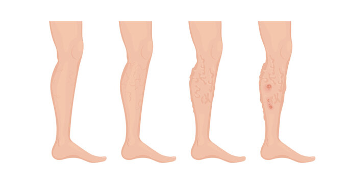 Stages of varicose veins developing on human leg, from healthy skin to thrombophlebitis