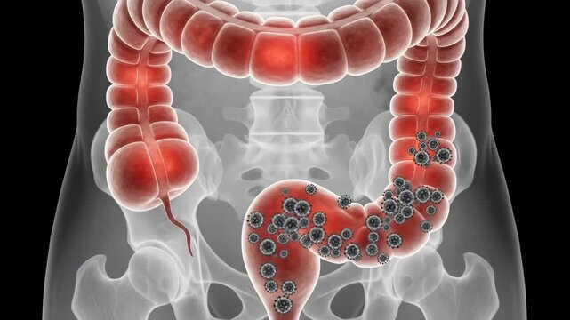 Detailed 3D animation showing viruses spreading through the human large intestine and colon causing inflammation